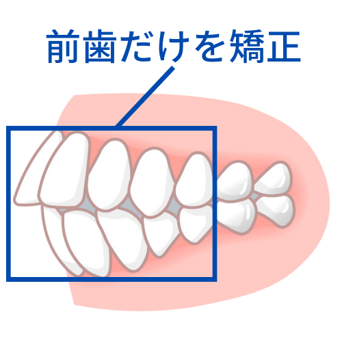 前歯だけを動かす矯正で失敗