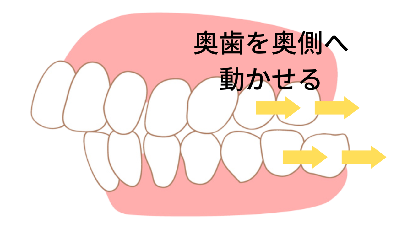 マウスピース矯正は目立たない